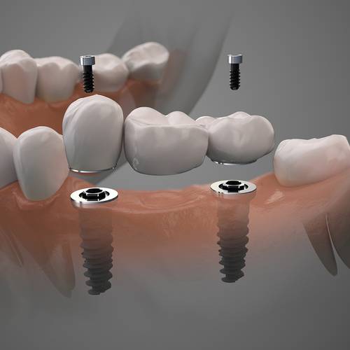 cosmetic dentistry cornerstone dental beaumont TX services dental implants image