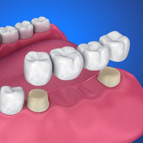 cosmetic dentistry cornerstone dental beaumont TX services dentures and bridges image